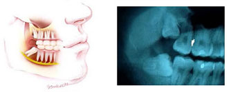 temsili resimdir. benimkisi daha vahim haldeydi...